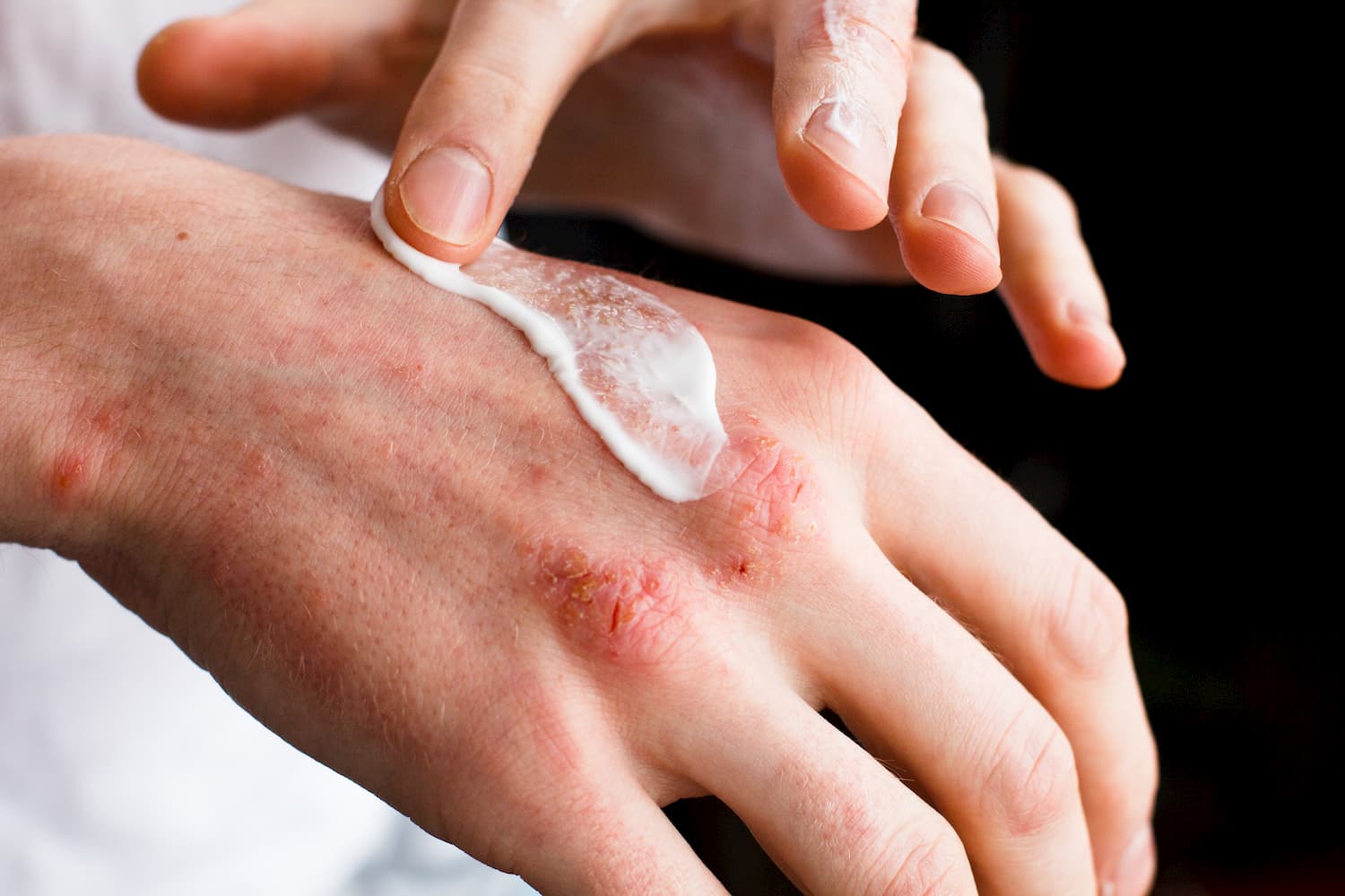 soigner eczema visage